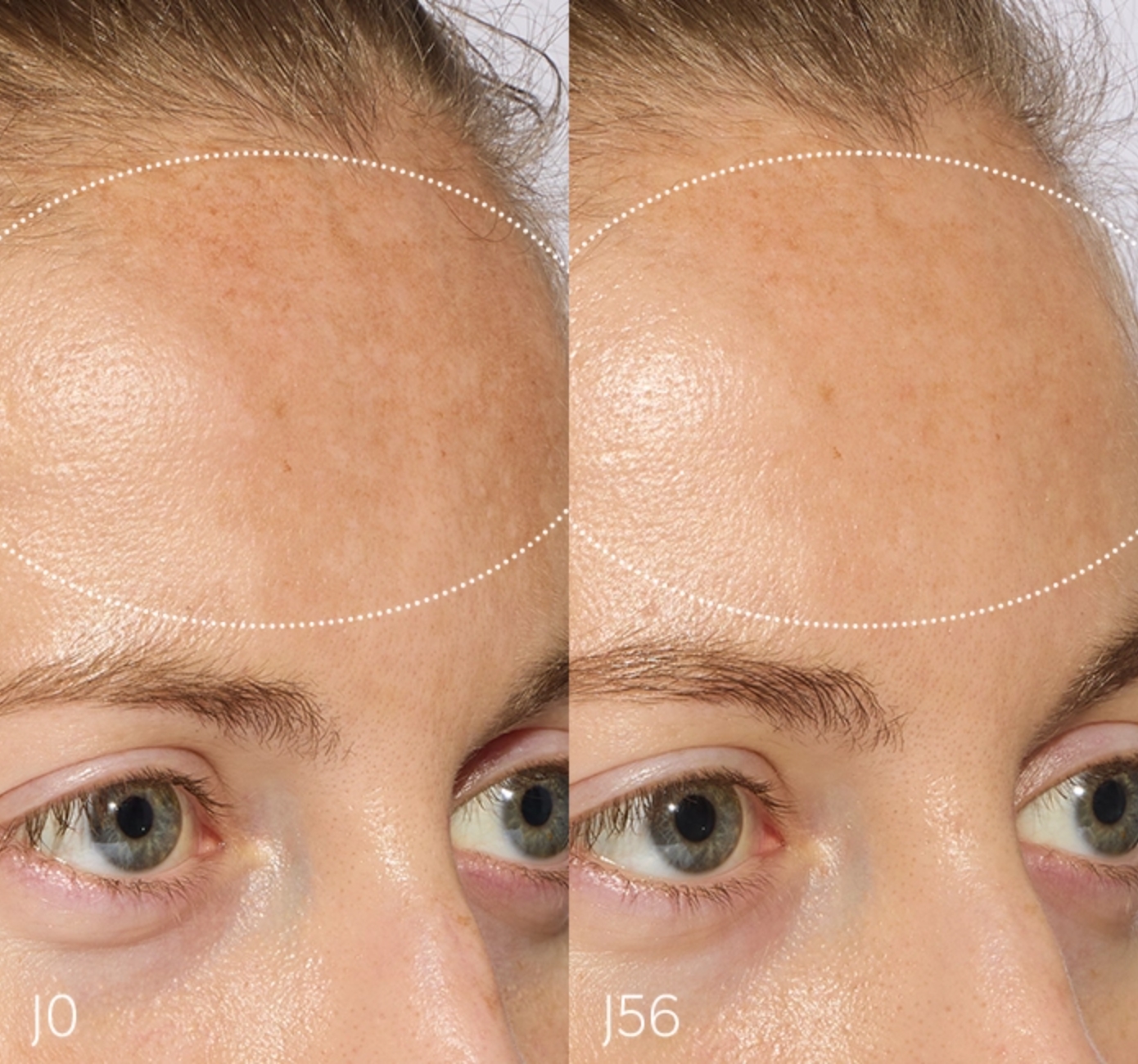 Comparison of a woman's forehead shows reduced pigmentation and improved skin tone from J0 to J56, marked by a dotted oval outline.