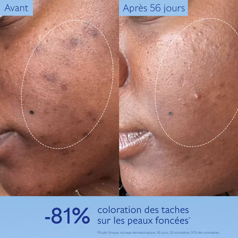 Photo avant-après 56 jours – Sérum Vinoperfect Caudalie : -81% de coloration des taches sur les peaux foncées selon étude dermatologique